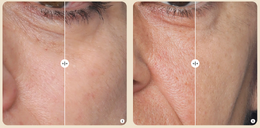 Silk'n přístroj na vyhlazení a redukci vrásek FaceTite ESSENTIAL